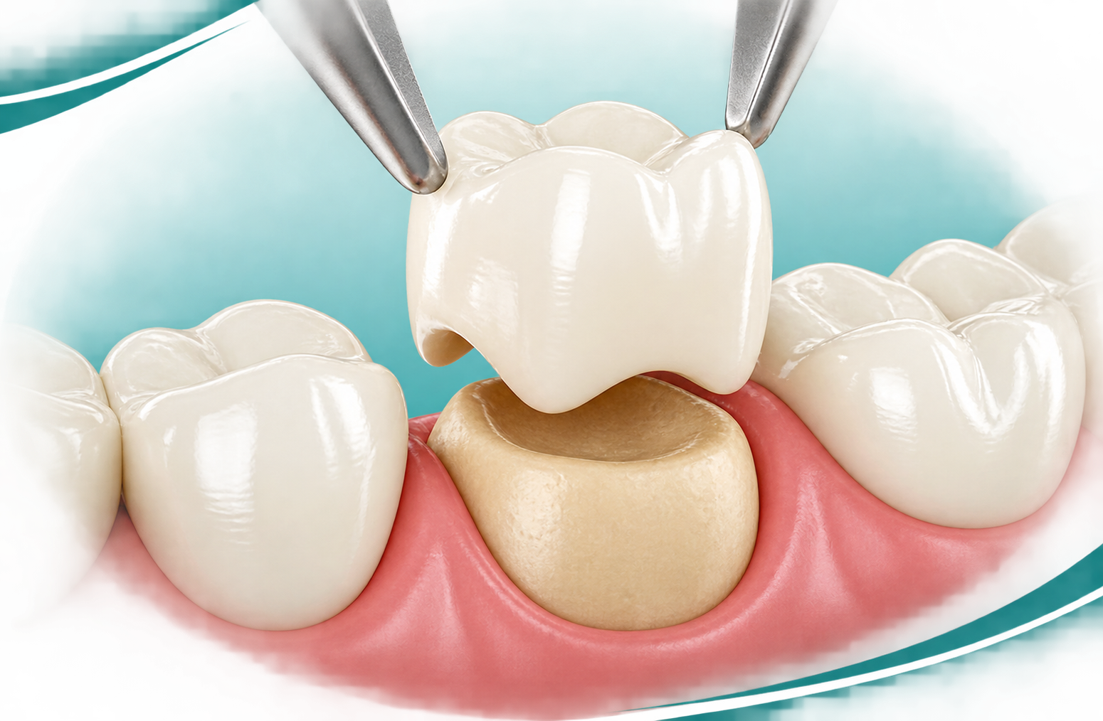 zirconium crowns