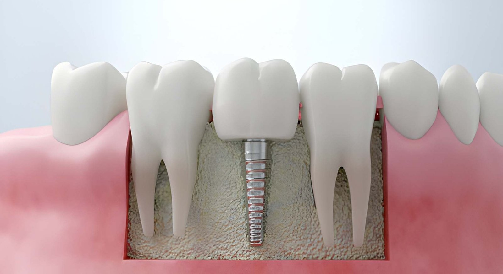 Dental Implants
