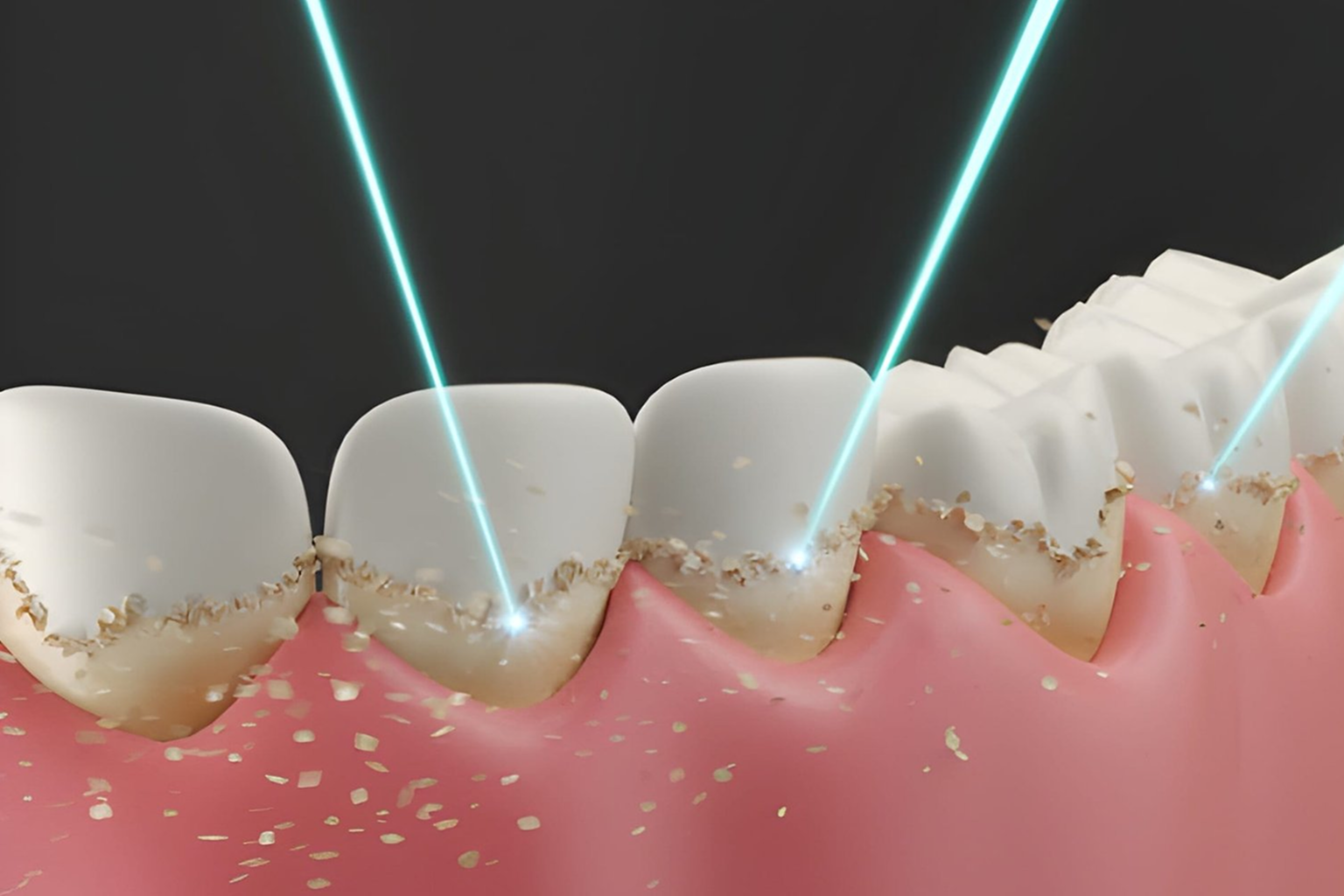 Advanced Laser Dentistry