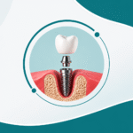 Dental Implants in Tellapur