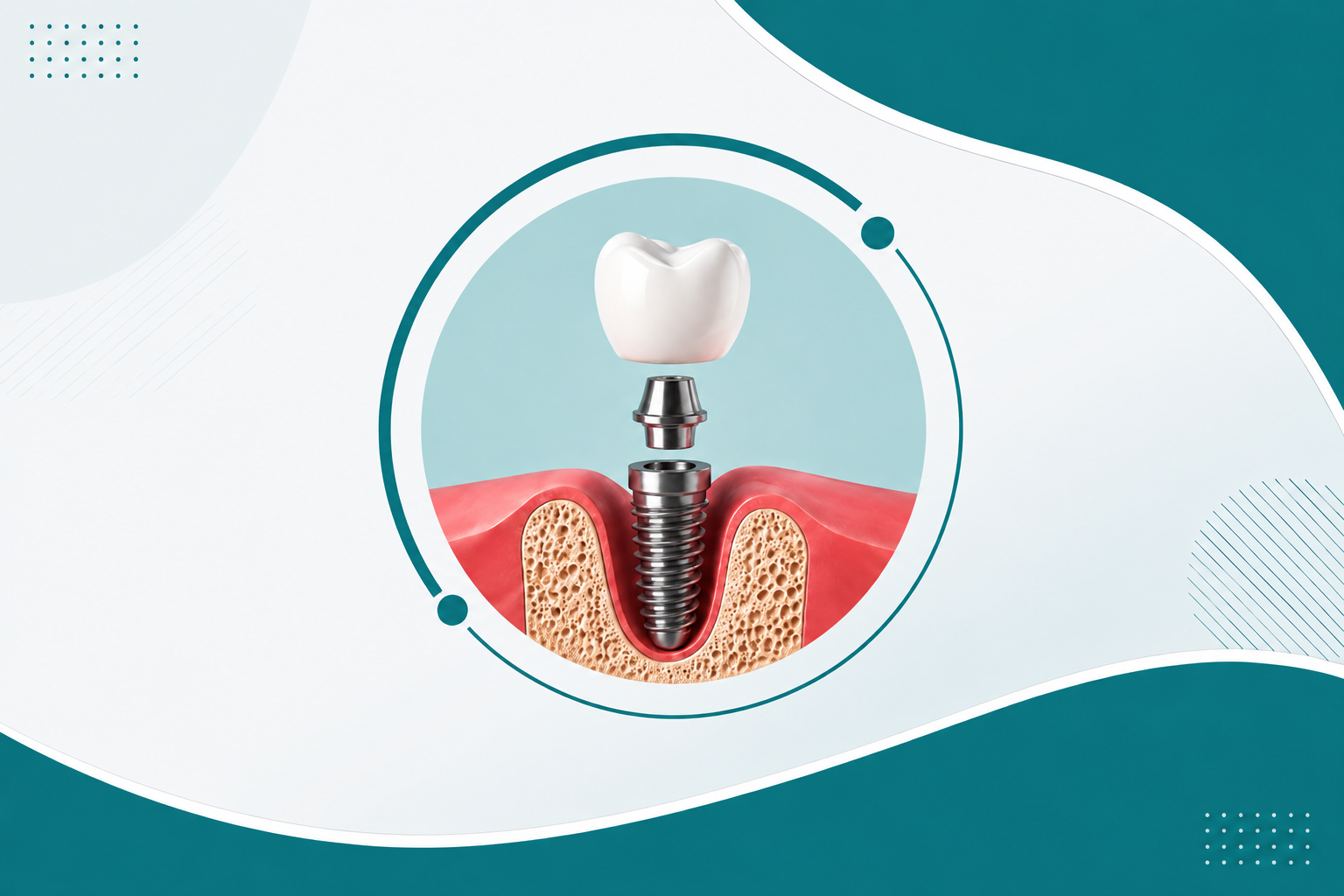 Dental Implants in Tellapur