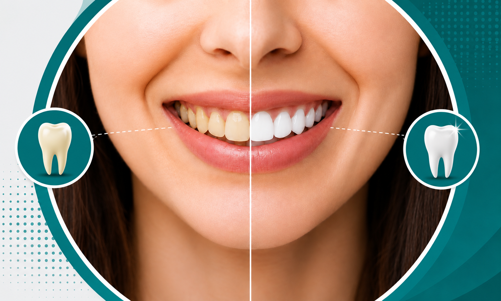 Teeth Whitening in Tellapur